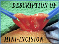 Mini Incision Vasectomy Reversal